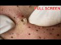 Blackheads Removal -  Best Pimple Popping Videos