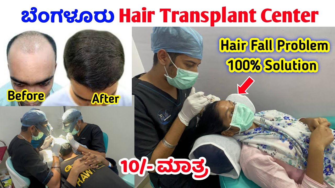 Hair Fall Treatment ₹10 /- || Hair transplant in Bangalore || Best