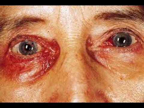 side-effects-of-prednisone---that-you-should-be-aware-of-before-using-❗