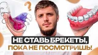 картинка: БРЕКЕТЫ – все, что нужно знать за 16 минут 33 секунд. Не наделай ошибок!