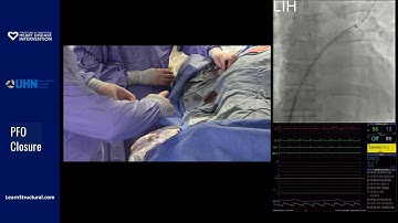 PFO Closure Procedure