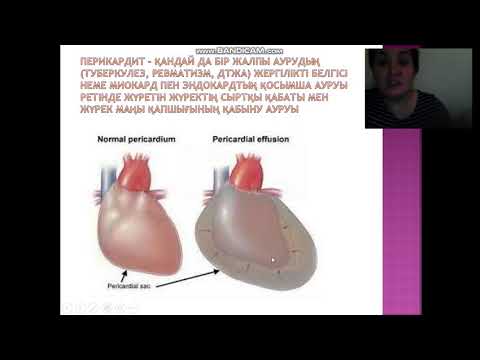 Бейне: Перикардитті қалай анықтауға болады: 12 қадам (суреттермен)