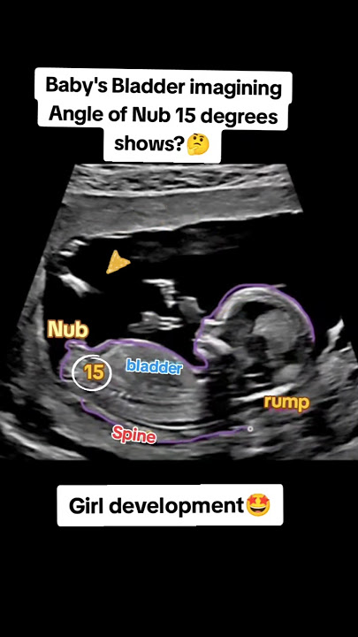 baby's bladder imagining angle of nub 15 degrees it's a girl🤩|#pregnancy #baby
