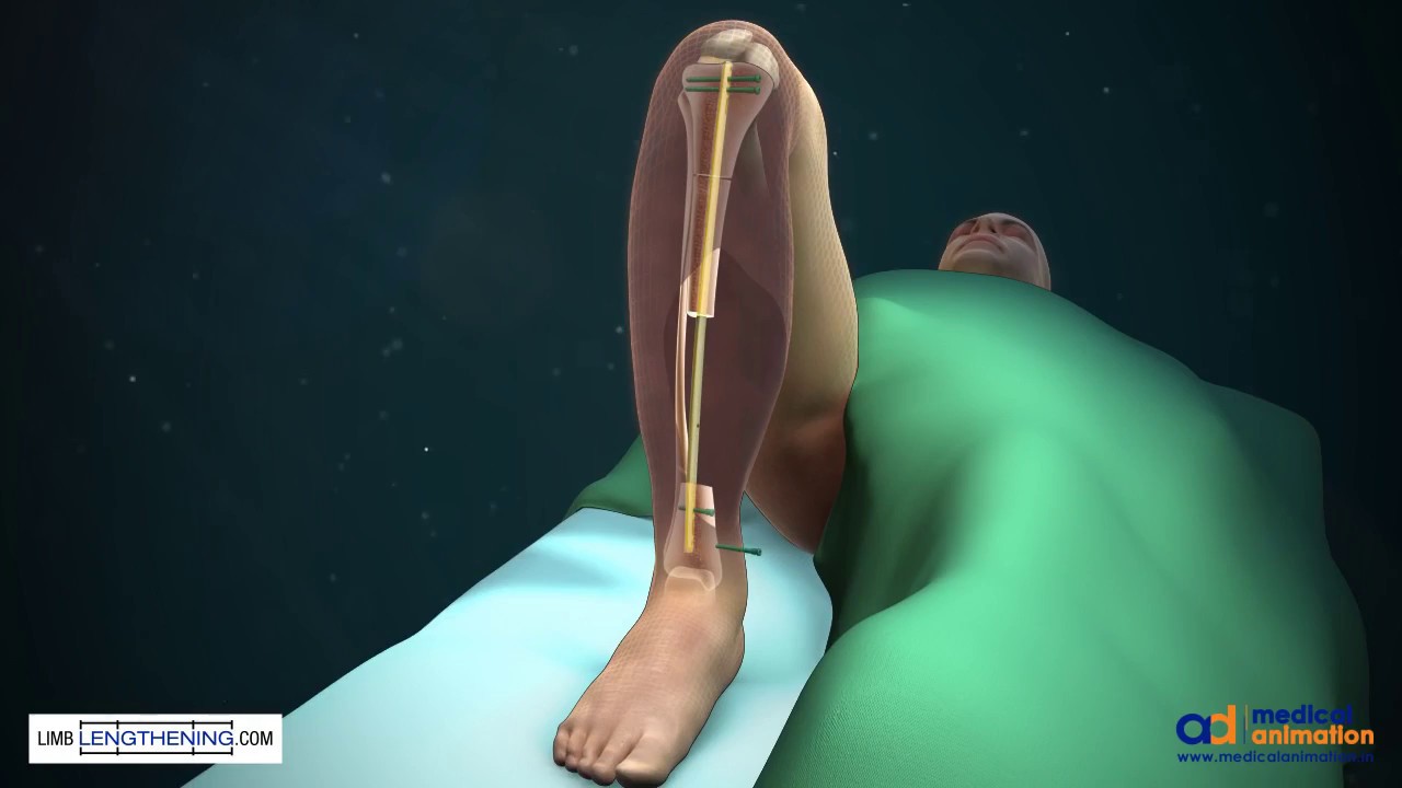 TIBIA FRACTURE CAUSED BY A BROKEN SCREW DURING INTERLOCKING INTRAMEDULLARY  NAIL EXTRACTION | Orthopedics