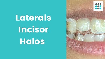 WHY LATERAL INCISORS DON’T TRACK #Shorts