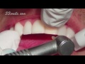 Prepless veneers dental procedure at cosmetic dental associates in san antonio tx