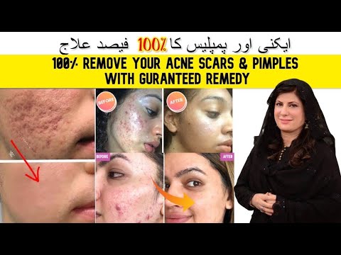 100% REMOVE ACNE SCARS, PIMPLES, ACNE WITH GUARANTEED TREATMENT IN URDU / HINDI BY DR BILQUIS SHAIKH