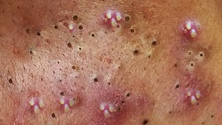 Acne treatment & blackheads with Tigon beauty #036