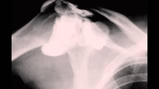 Rotator Cuff Tear on Shoulder Arthrogram