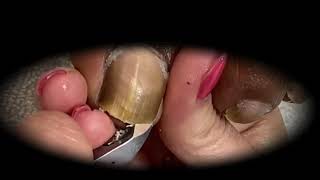 Ingrown Toenails Treatment Satisfying Pedicure Manicure #7