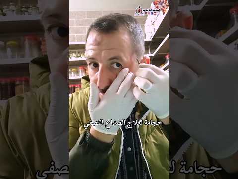 حجامة لعلاح الصداع النصفي والام الشقيقة  الحجامة 