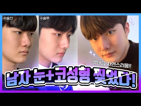 남자 눈, 코 성형 찢었다!