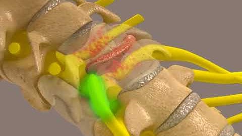 How Cervical Decompression Works with the KDT Decompression System