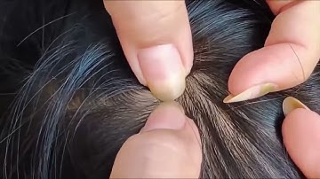 Head lice often strike when you least expect it even at night