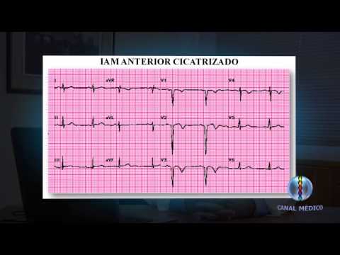 Vídeo: Eletrocardiografia Serial Para Detectar Patologia Cardíaca Recém-emergente Ou Agravante: Uma Abordagem De Aprendizado Profundo