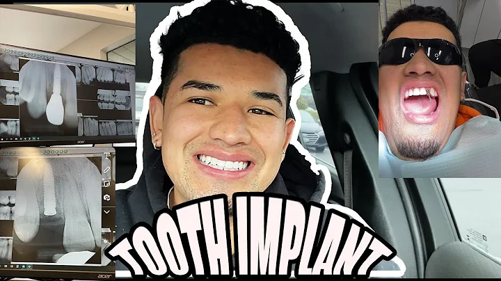 FINALLY GOT MY TOOTH IMPLANT! AFTER 2 YEARS! ITS BEEN A JOURNEY!