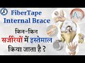 किन-किन सर्जरियों मे इस्तेमाल कर सकते है FiberTape Internal Brace? ACL, Knee, Shoulder, Ankle, Elbow