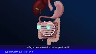 Bypass Gastrique Roux En Y