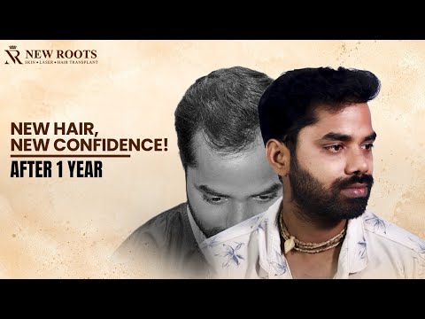New Hair, New Confidence! 😎 | 3000 Grafts | 1 Year Results | Hair Transplant in Raipur | Hindi
