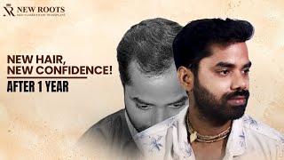New Hair, New Confidence! 😎 | 3000 Grafts | 1 Year Results | Hair Transplant in Raipur | Hindi