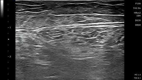 Saphenous nerve infrapatellar branch