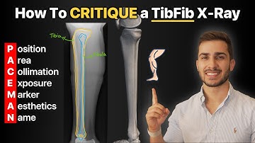 How To Critique a Tibia & Fibula (TibFib) X-Ray!