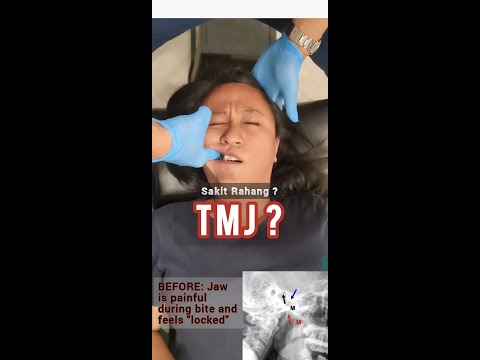 Video: Cara Merawat Masalah TMJ Tanpa Pembedahan: 15 Langkah