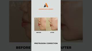 Protrusion Correction | Answer Plastic Surgery shorts protrusioncorrection