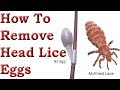 How to Remove Head Lice Eggs. (  हेड जूँ अंडे कैसे निकालें )