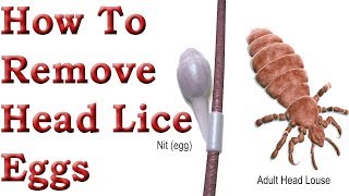 How to Remove Head Lice Eggs. ( हेड जूँ अंडे कैसे निकालें ) - YouTube