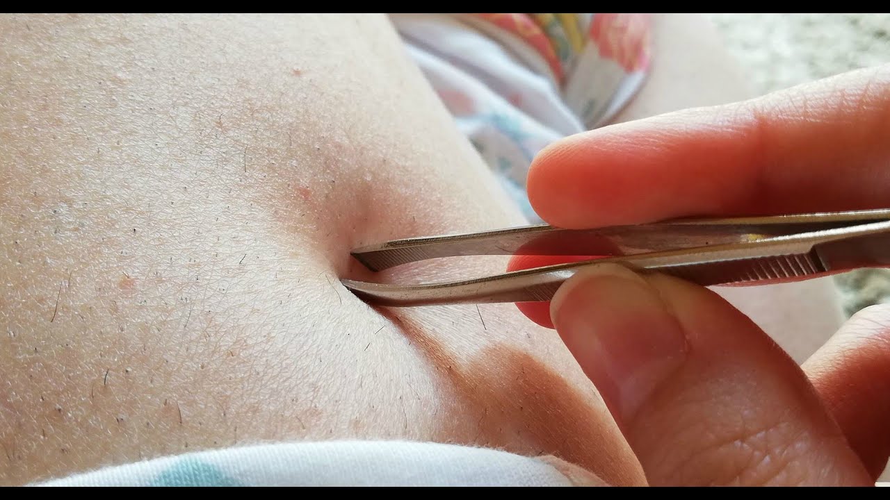 Removing Ingrown Hairs Удаление вросшего волоса зона