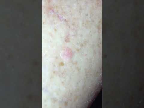 bumps-like-this-started-appearing-on-my-leg-always-below-the-knee