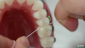 How to floss with braces | Evolution Orthodontics