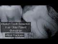 Root fracture and removal with wisdom tooth extraction drwahan