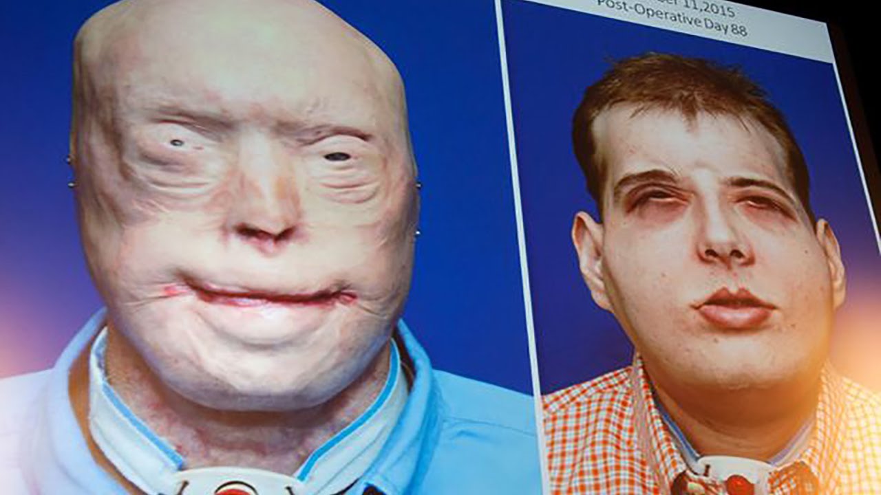 Meet The Man With The Most Extensive Face Transplant EVER
