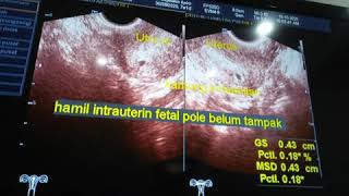 Hamil 7 Minggu Kantong Kehamilan 4 Minggu