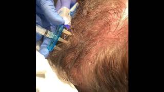 Platelet Rich Plasma (PRP) Injections for Hair Growth | Dr. David P. Rapaport NYC