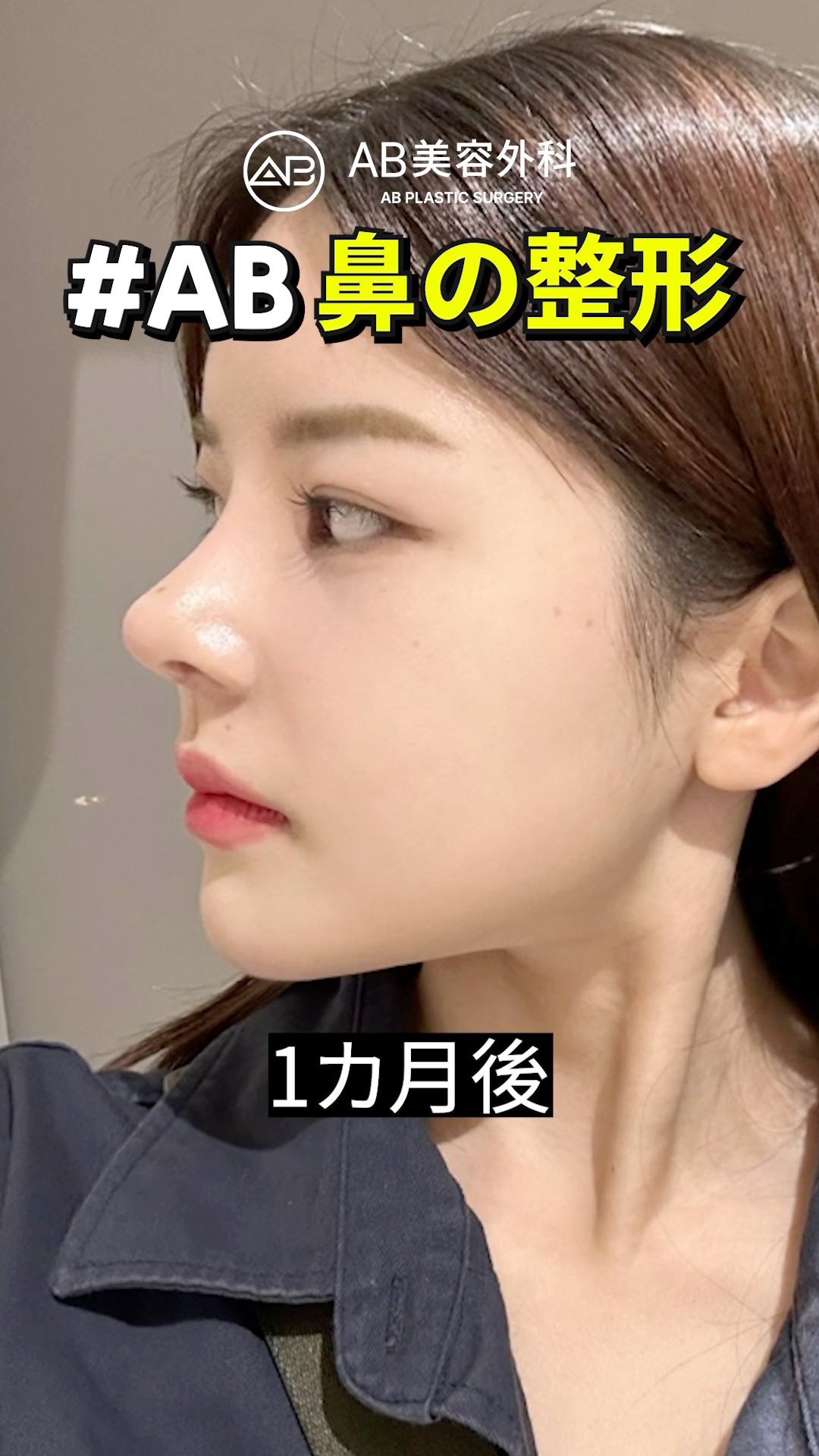 鼻整形から1ヶ月後…横顔がこんなに綺麗に?! | AB美容整形