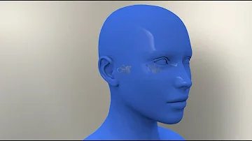 Cosa scatena la sindrome di Ménière?