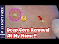 My Way of Working At Home *** Deep Corn Removal At home *** Full treatment by Miss Foot Fixer