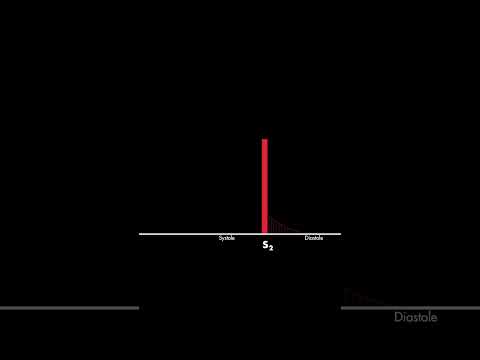 Aortic Regurgitation