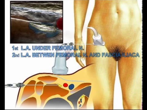 all you need to know about femoral nerve block - youtube all you need to know about femoral nerve block - youtube, Muscles