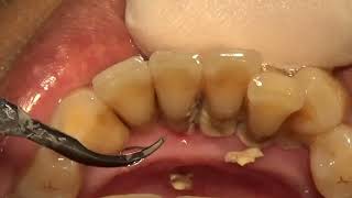 50 yo. Male&#39;s Teeth | Scaling | Dentist | Dokter Gigi Ruliyanto