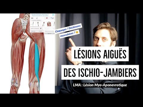 Vidéo: Tendinite Des Ischio-jambiers: Traitement, Récupération Et Plus