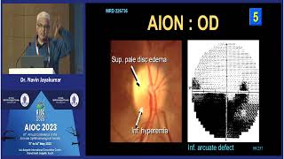 AIOC2023   IC123   topic Dr Navin Jayakumar Visual field analysis   an invaluable tool News