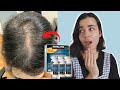 Gambar cover Can Women Use Minoxidil Rogaine 2022 | WATCH THIS before starting Minoxidil