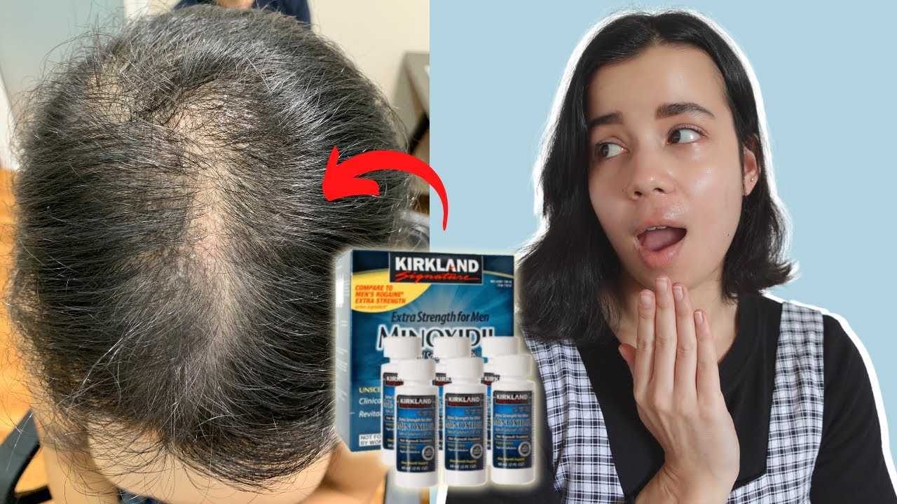 Why can't girls use minoxidil?