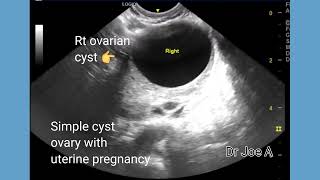 Simple cyst of ovary with early pregnancy, transvaginal ultrasound video