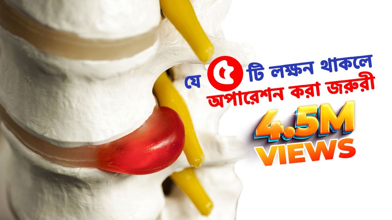 Disc Prolapse/ডিস্ক প্রলাপ্স বা কোমর ব্যথায় যে ৫ টি লক্ষন থাকলে অপারেশন করা জরুরী
