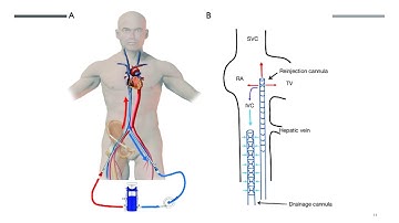 ECMO troubleshooting (real case story: case 1)